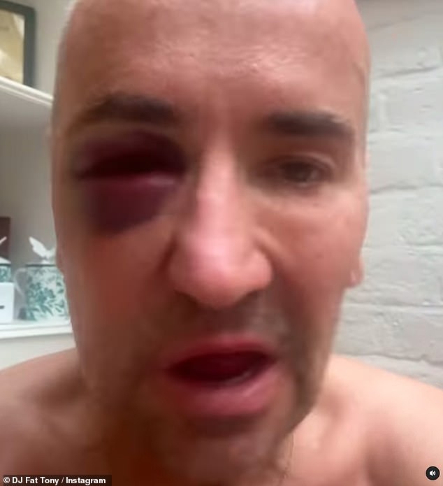 He added: 'It resulted in me being knocked unconscious, taken to hospital and in A&E all night. You can clearly see the damage to my face and the swelling - it's not good'