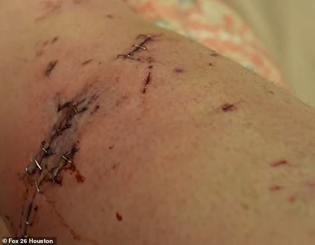 She had bite marks all over her body and required 180 stitches and 90 staples to close deep wounds in her head, arms and neck