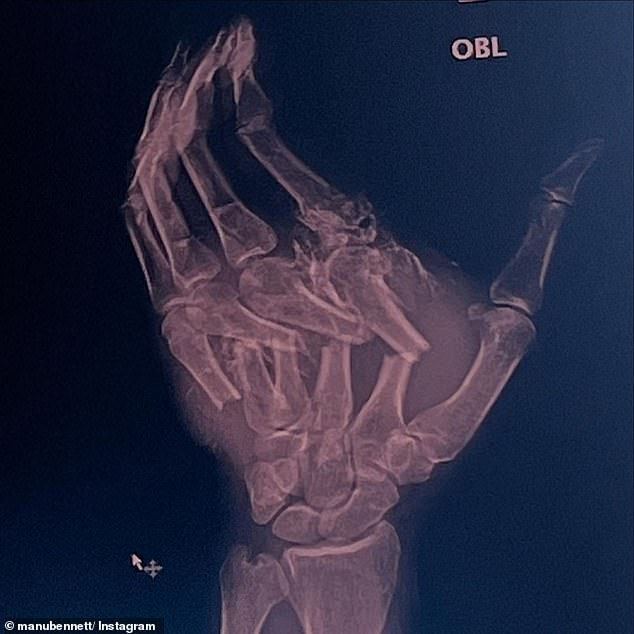 The 55-year-old actor, known for his roles in Spartacus and The Hobbit trilogy, shared an x-ray of his hand after the 'nasty' accident