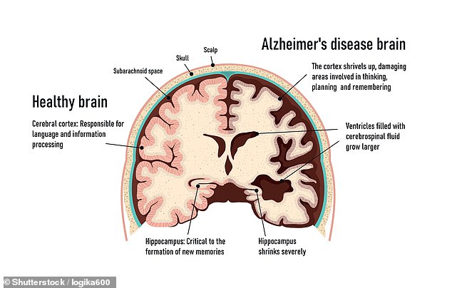 As people age, the amount of healthy tissue in the brain begins to naturally thin. In Alzheimer's disease, this happens much more quickly, leading to the memory loss, personality changes and confusion that often accompany the disease.