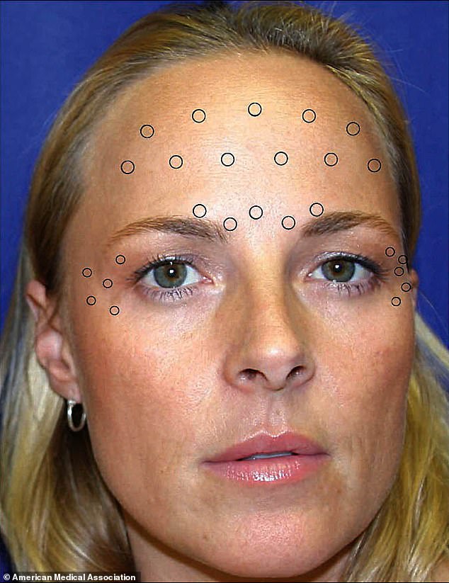 Pictured are the areas where twins received Botox injections in the forehead, glabellar (between the eyebrows) and crow's feet