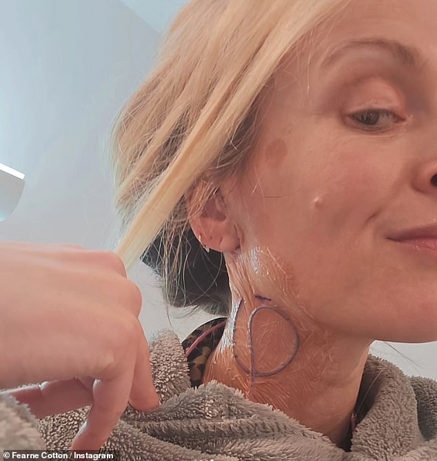 Taking to Instagram on Saturday, Fearne shared photos of her scar as it improved after surgery