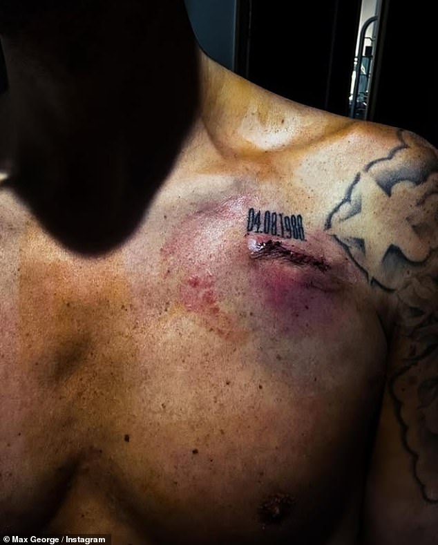 The Wanted star, 36, who has been in hospital for a week with a 2:1 atrioventricular block and is awaiting a pacemaker, shared a photo of his new scar, which lies next to a 'special tattoo'