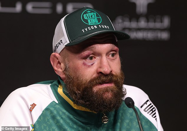 After the fight, Fury showed off his bruised right eye as a result of Usyk's powerful punches