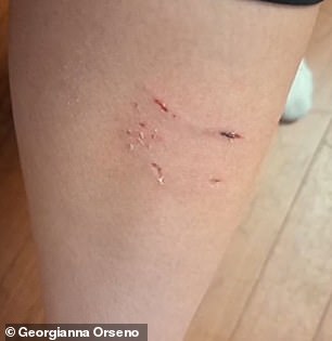 'This is the worst bite, on my ankle here. It bleeds through. My pants are all torn from the other bite,” she said