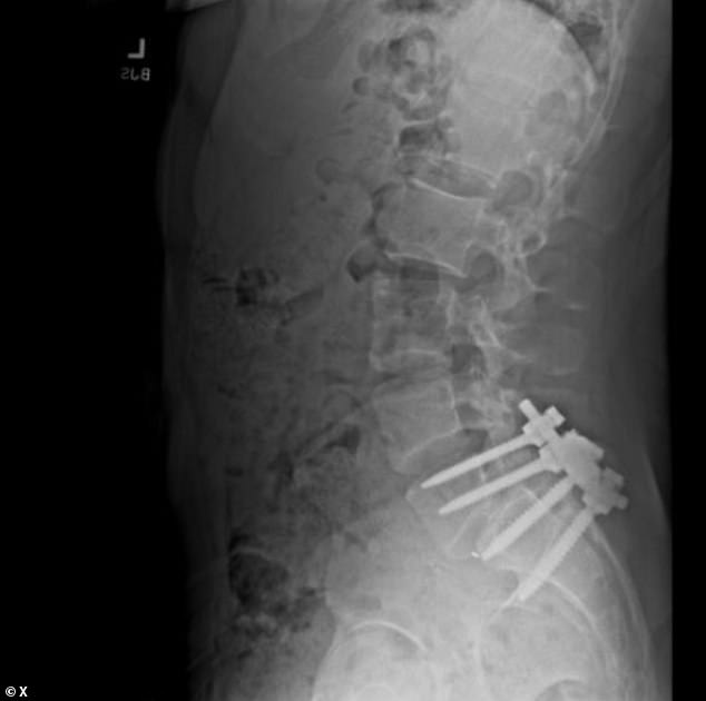 An image on an X account linked to Mangione showed an x-ray of a metal rod and multiple screws inserted into his lower back