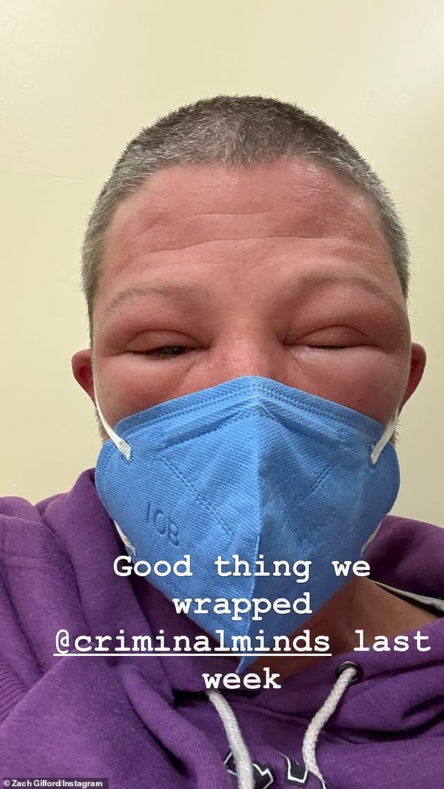 Last Monday, Zach shocked his 72,000 Instagram followers by posting photos of what appeared to be angioedema, which can cause life-threatening anaphylaxis if the swelling blocks the airways.