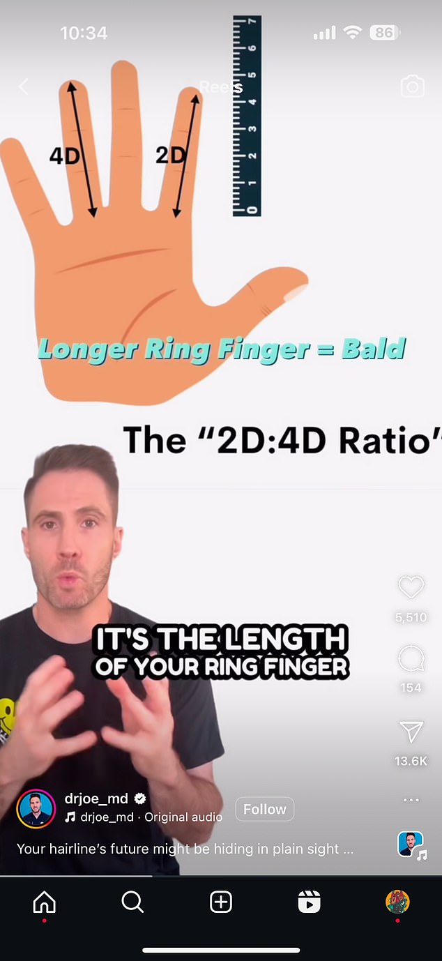 According to the emergency doctor, the '2D:4D ratio', the length of the ring finger compared to the length of the index finger, helps determine the risk of hair loss