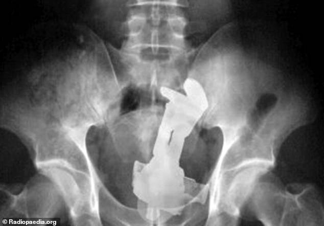 Doctors also told DailyMail.com about previous situations where people arrived at the ER with Buzz Lightyear stuck in their butt