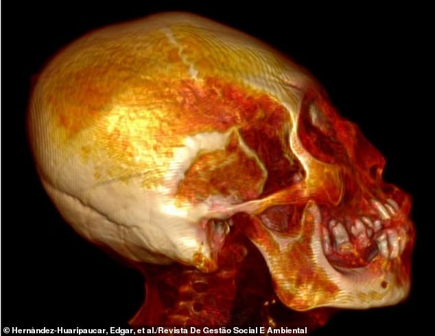 The elongated skull showed no signs of artificial skull deformation and was 30 percent larger than that of a normal human