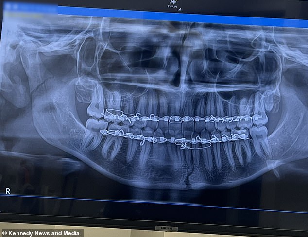 An ambulance took Wasim to hospital where she underwent an X-ray and a CT scan, and she was 'shocked' to discover she had suffered two fractures in her jaw