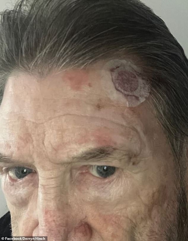 Derryn also recently underwent five weeks of daily radiotherapy amid a 'quite serious' battle with skin cancer after doctors found a melanoma on his forehead (pictured)