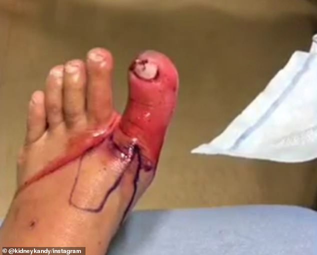 The former nurse, who has type 1 diabetes and is more prone to foot injuries due to poor circulation, was accidentally cut with a nail file during the salon visit