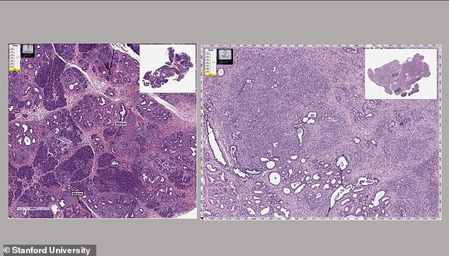 The above shows the cancerous pancreas of mice before (left) and after (right) they were treated with mebendazole, an antiparasitic drug approved for use in humans