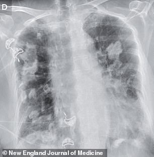 The above image is a scan of one of the patient's two sisters. They both developed pleural plaques, which could be the result of exposure to asbestos as children