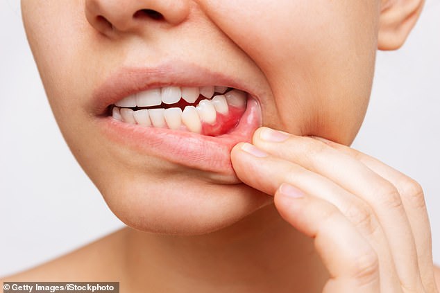 Treponema denticola – is strongly associated with gum disease, which is the main reason people lose their teeth (Stock Image)