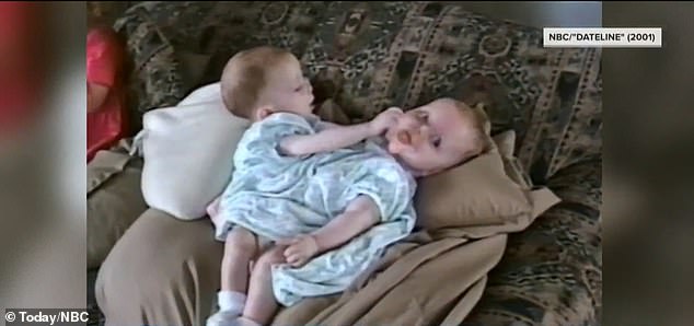 She and twin sister Kathleen were attached from the sternum to the pelvis when they were born in 2000. The sisters, who each had one leg, shared several internal organs and a third fused leg.