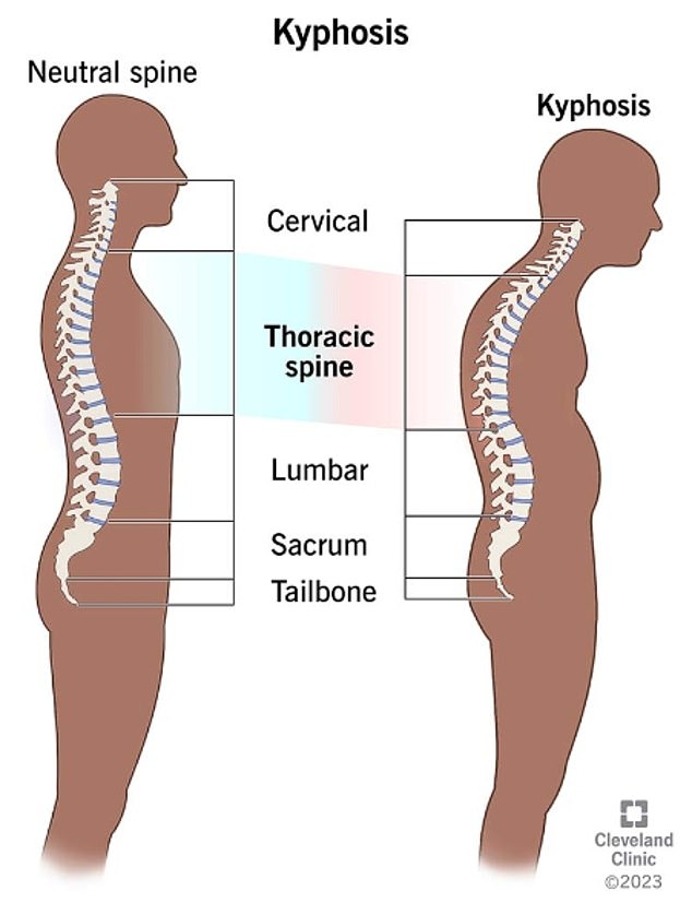 Kyphosis, also called round back or hunchback, affects more than 3 million people per year in the US