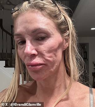 Brandi Glanville says doctors suspect her facial condition could be caused by a parasite hopping around her face; seen in December 2024