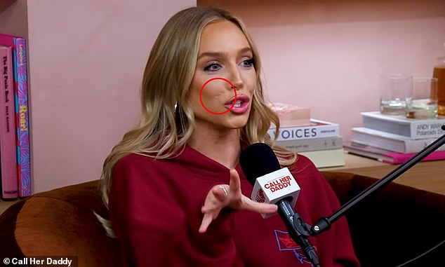 Keen-eyed viewers of the Call Her Daddy podcast share theories about what may have happened to popular host Alex Cooper's face