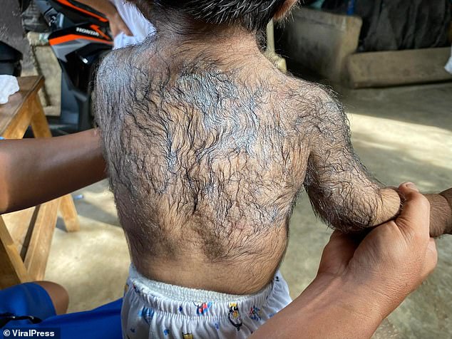 'Werewolf syndrome' causes abnormal amounts of fine hairs up to 5cm long to grow on a person's face, arms and other parts of their body. Stock image