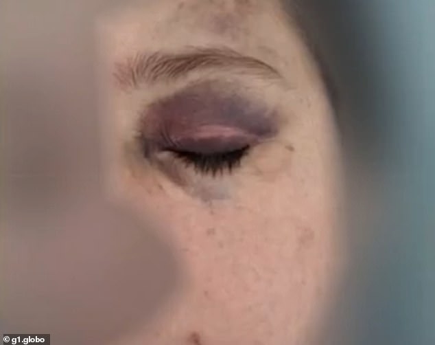 The woman suffered a bruised eye after being beaten by a member of São Paulo's military police in October when they tried to arrest her outside her home.