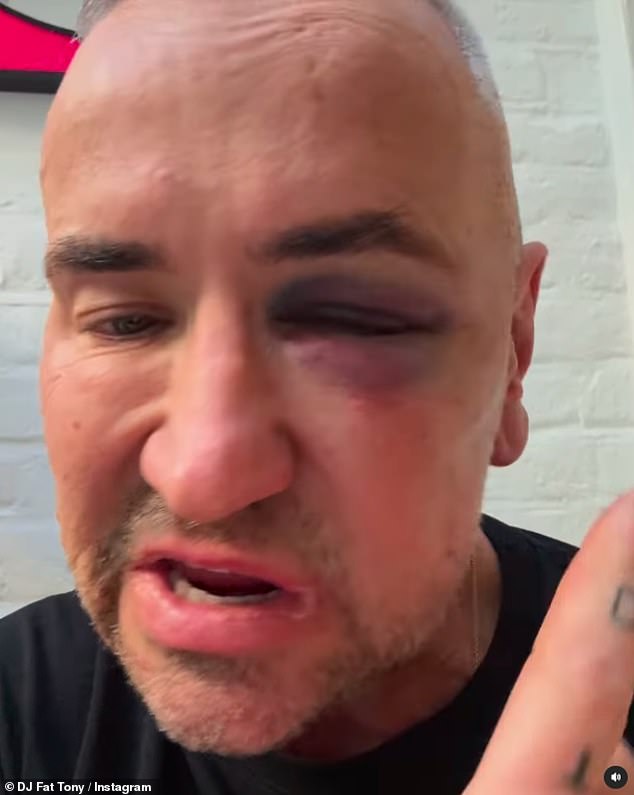 DJ Fat Tony revealed shocking facial injuries as he revealed he was attacked during a gig this weekend