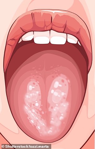 White spots on the tongue usually occur due to poor oral hygiene, smoking or chronic alcohol consumption