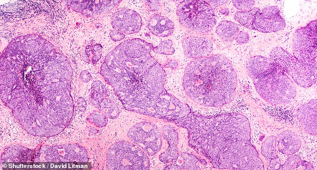 Ductal carcinoma in situ, or DCIS, is a slow-growing type of the disease that resides in the milk ducts and is routinely picked up by screening. Pictured: DCIS in breast tissue