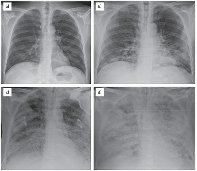 Pneumonia causes white spots or opaque areas in the lungs. The above patient was a 57-year-old man in 2014