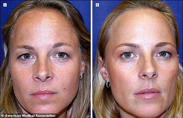 Similar to the fruit and vegetable study, a separate 2024 study showed the difference in twins who received very few Botox injections - Figure A - next to twins who received regular Botox - Figure D