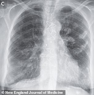 The above image is a scan of one of the patient's two sisters. They both developed pleural plaques, which could be the result of exposure to asbestos as children