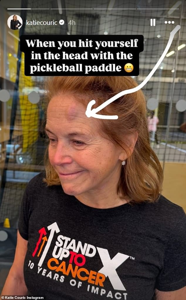 Katie Couric showed off a nasty pickleball injury in a shocking Instagram photo on Friday