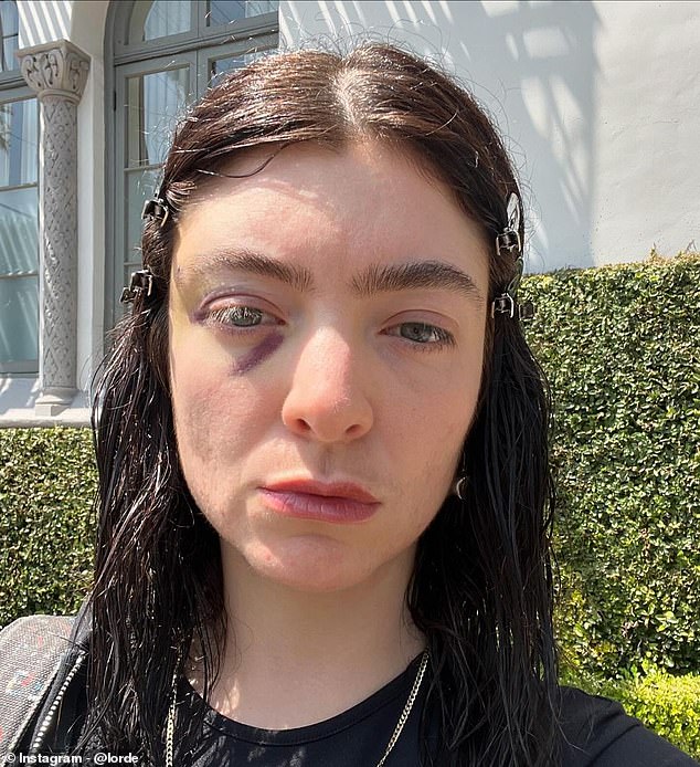 Last month, Lorde sparked concern on Monday after she shared a series of photos on Instagram showing a black eye