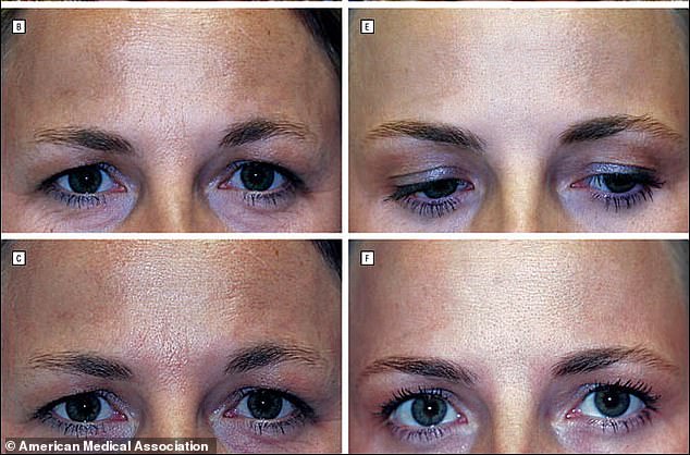 The images show that the twins who received very few injections – images B and C – and the one who received regular Botox – E and F – had significantly more forehead wrinkles