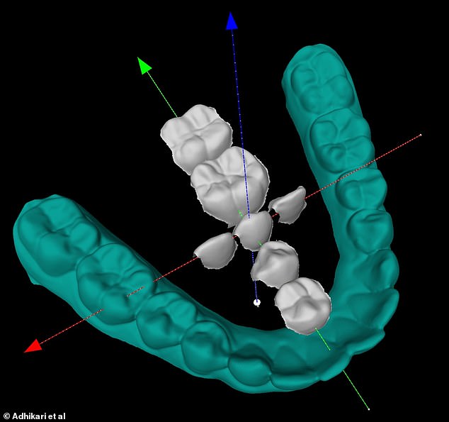 The photo shows an example of the dental scans that researchers used to measure tooth dimensions. However, they don't know if this comes from a person who carries the Neanderthal gene. The blue teeth show the arrangement of the teeth in our lower jaw as it would be naturally. This is called our dental arcade. The white teeth are aligned versions of the same teeth, where they are all aligned in the same direction: width, height, thickness