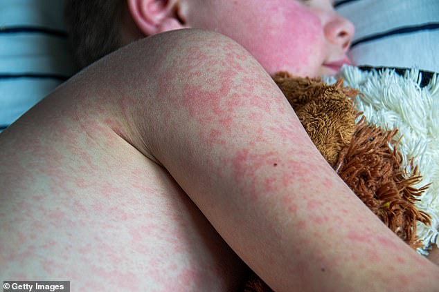 Passengers on flight SQ225 Singapore to Perth on Sunday are being warned to watch for measles symptoms (stock image of measles)