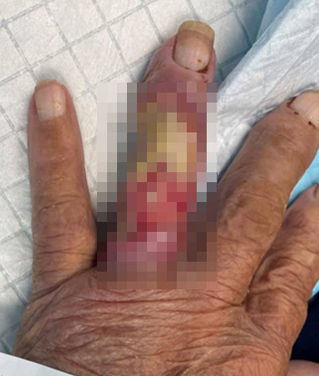 The 94-year-old man in Bateman Bay lost one of his fingers (pictured) to the flesh-eating disease after injuring the ring finger of his left hand when he injured it on an outdoor table in 2020