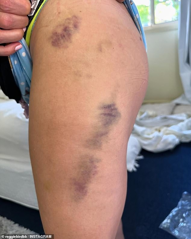 Reggie took to the social media platform again on Friday and shared the shocking results of her big night. Her leg was covered in dark bruises after she 'fell over'