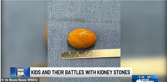 One stone in Alex's kidney was the size of a golf ball, while the other in his bladder was the size of a lacrosse ball