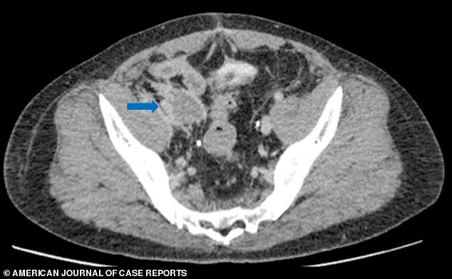 On this CT scan, after the patient was discharged for the first time, doctors found a blood clot in the left iliac artery, marked by the blue arrow. They also found a blood clot that had traveled to the man's lungs