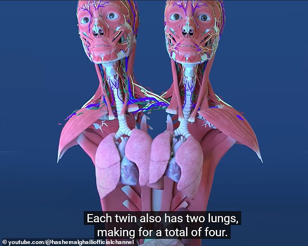 Each twin has two lungs (two partially fused), two stomachs, two gallbladders, three kidneys, one liver, one small intestine, one large intestine, one pelvis, one bladder, one set of reproductive organs