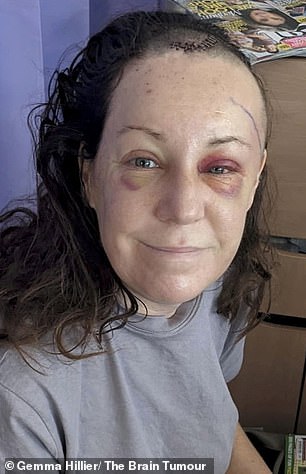 The teacher (pictured after surgery) who thought she could see well was referred to an eye clinic for further examination and in November 2023 she had an MRI scan, which revealed she had a benign brain tumor.