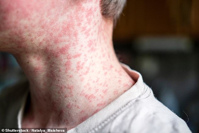 Symptoms of measles include fever, coughing, runny nose, sore or red eyes and a general feeling of being unwell. This is followed by a red maculopapular rash (stock image)