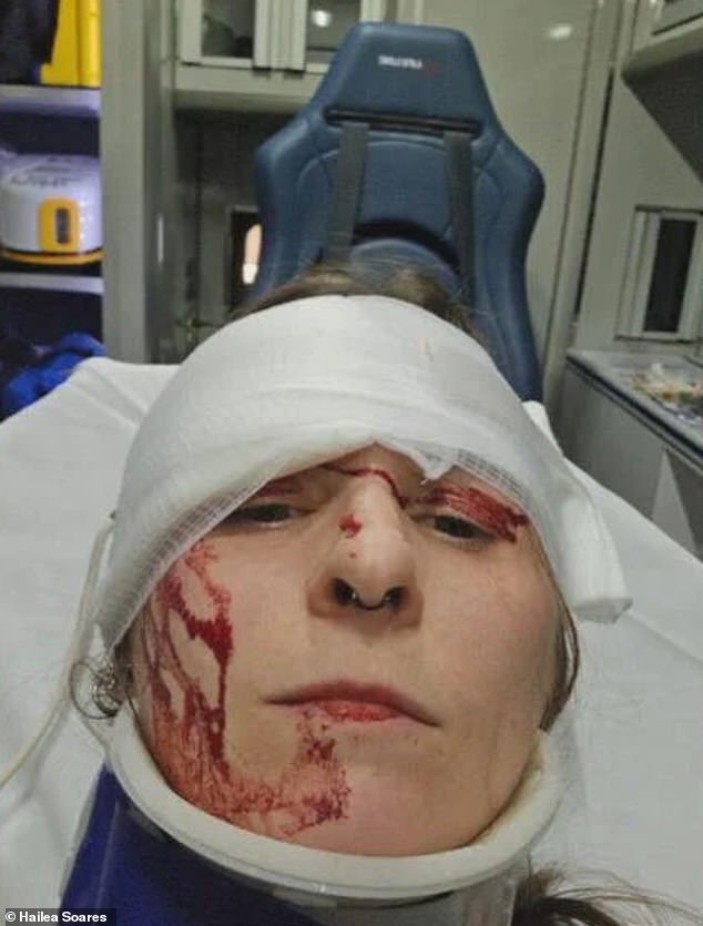 Soares had to get eight stitches in her head and was left with a serious eye socket injury