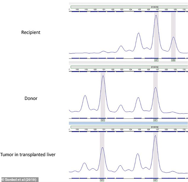 The graphs above show that the genetic makeup of the tumor in the man's transplanted liver is the same as that of the donor