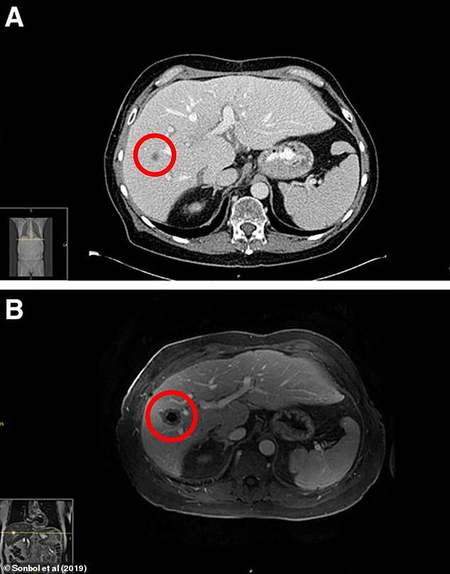 The images above show a CT scan of the liver tumor (top, circled) and an MRI of the liver tumor (bottom, circled)