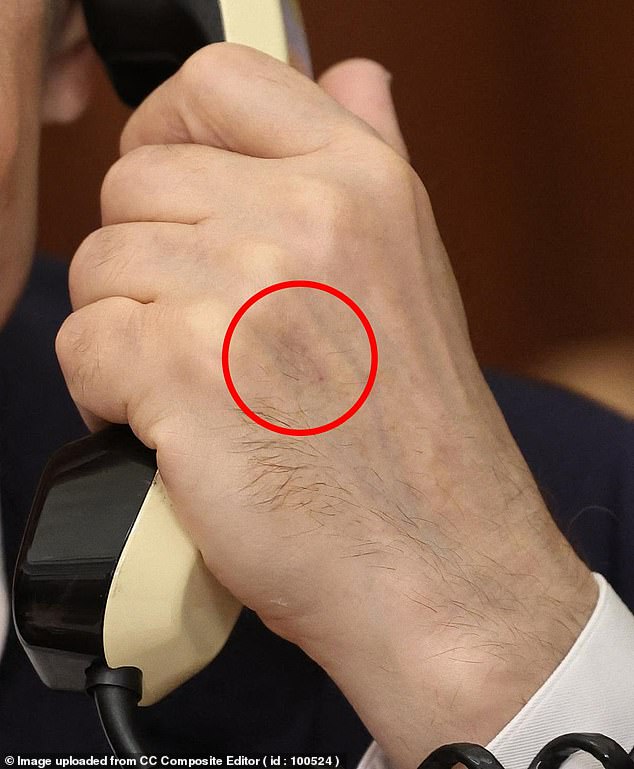 It is not known why the 72-year-old Russian leader has this bruise, but it is believed that his health has been poor for a long time