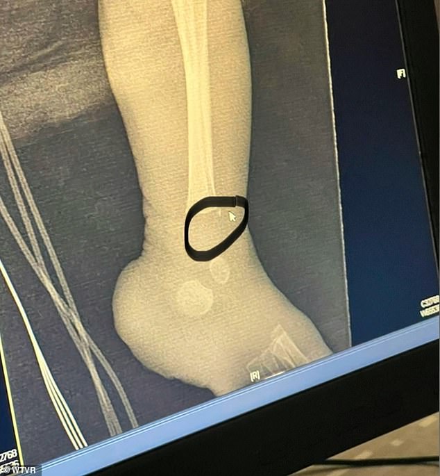 In the photo: an X-ray of the fracture of Noah's leg, taken by his father Dominique Hackey