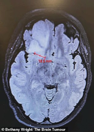 She worried she might have preeclampsia - a pregnancy complication that causes high blood pressure - but a CT scan showed a mass in her brain instead (pictured)